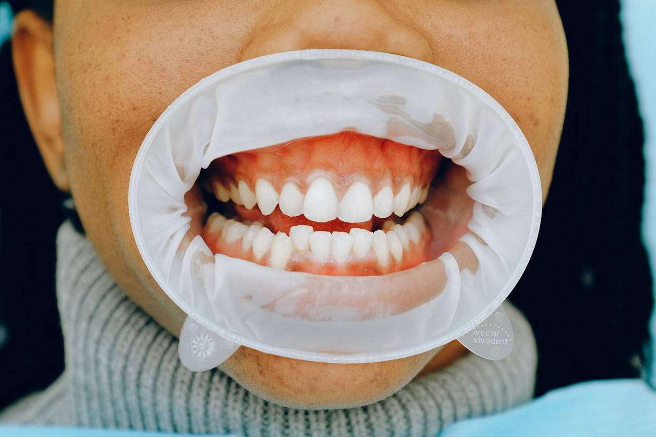 Close-up view of a patient's mouth during a dental examination, showing healthy teeth and gums with a dental cheek retractor in place